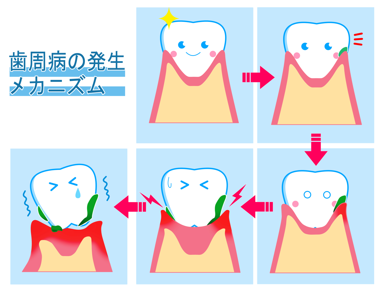 歯周病の発生メカニズム